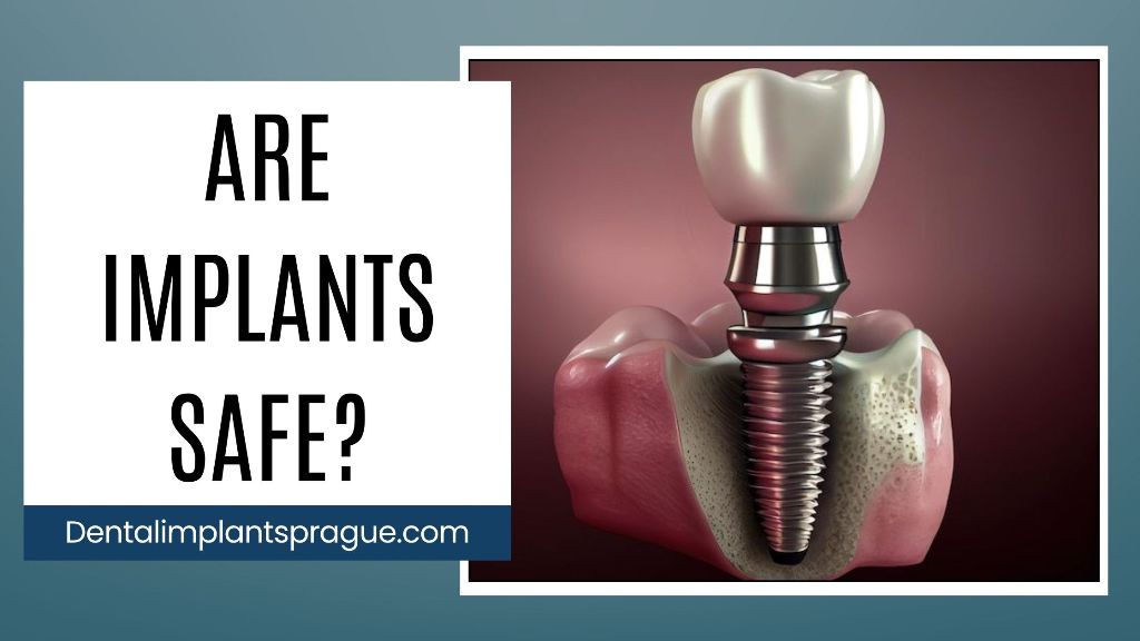 Are Implants Safe?