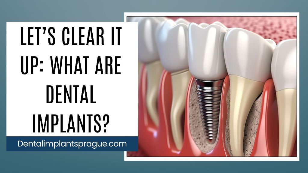 Let’s Clear It Up_ What Are Dental Implants